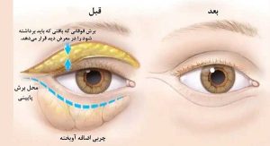 نحوه انجام بلفاروپلاستی