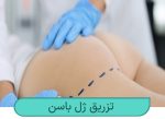 تزریق ژل به باسن